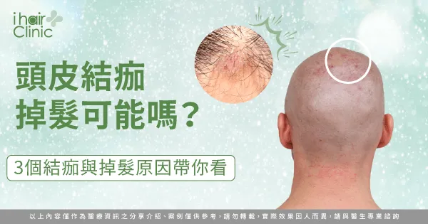 3個原因分析頭皮結痂掉髮的可能性-頭皮結痂掉髮