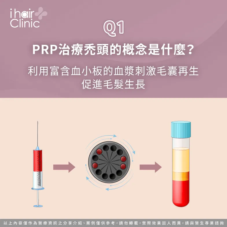 prp治療禿頭概念-PRP治療禿頭