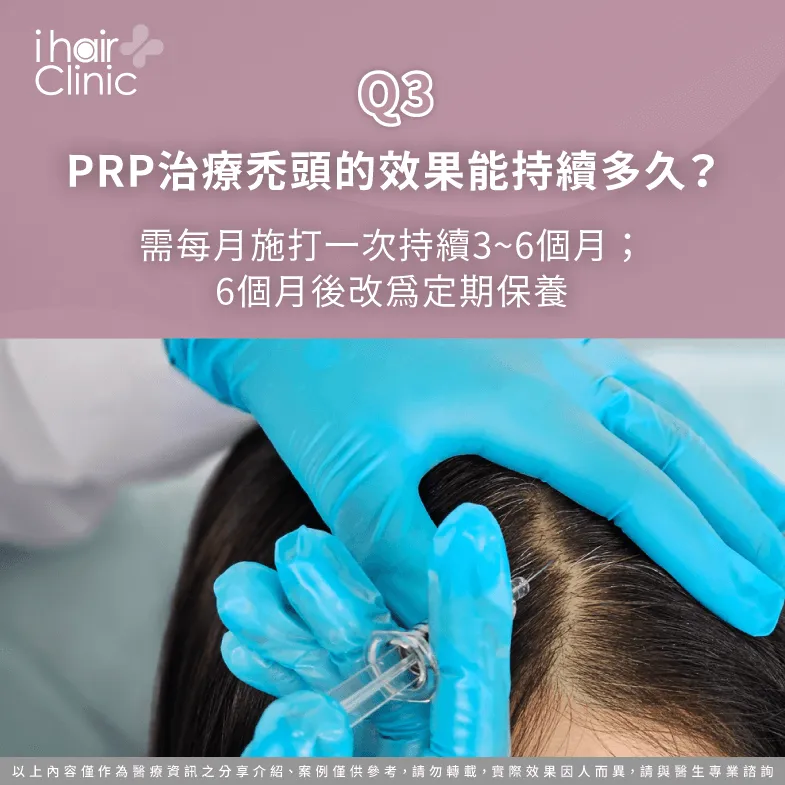 prp治療禿頭效果持續時間-PRP治療禿頭