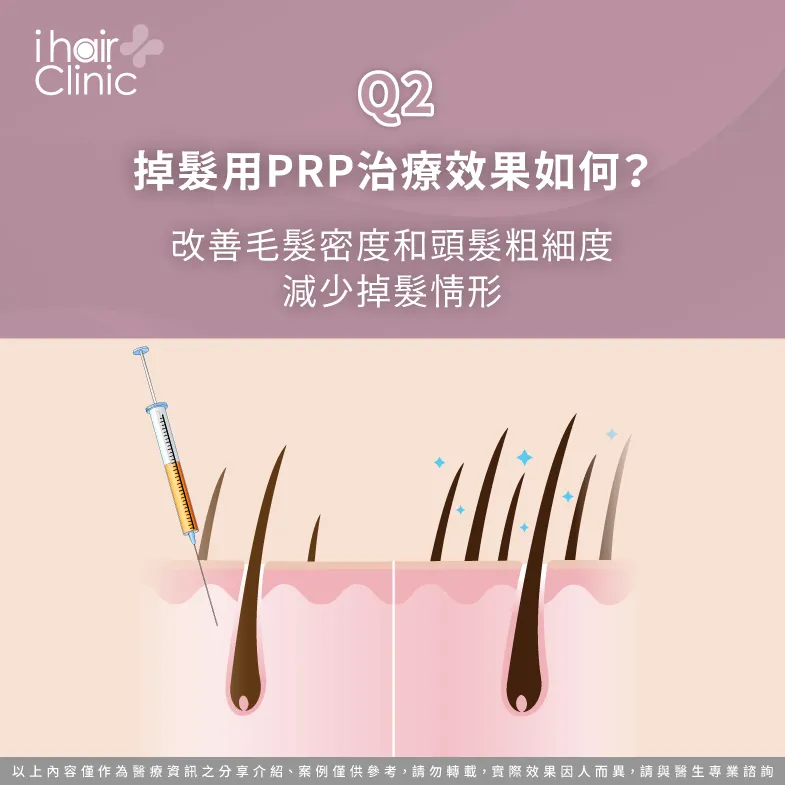 prp治療禿頭效果-PRP治療禿頭