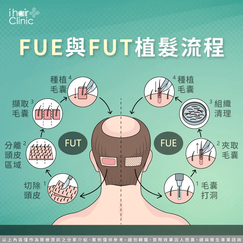 FUT與FUE植髮-植髮費用要多少