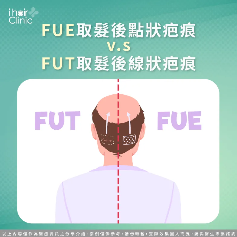 FUT與FUE疤痕-植髮費用要多少