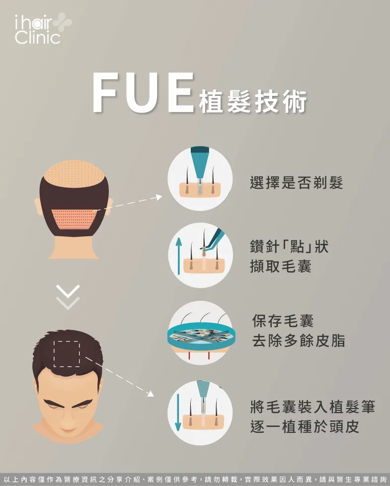 FUE植髮手術是什麼-植髮是什麼