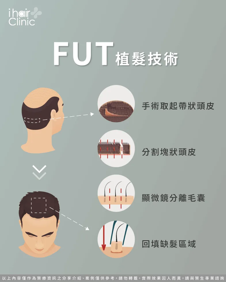 FUT植髮手術是什麼-植髮是什麼