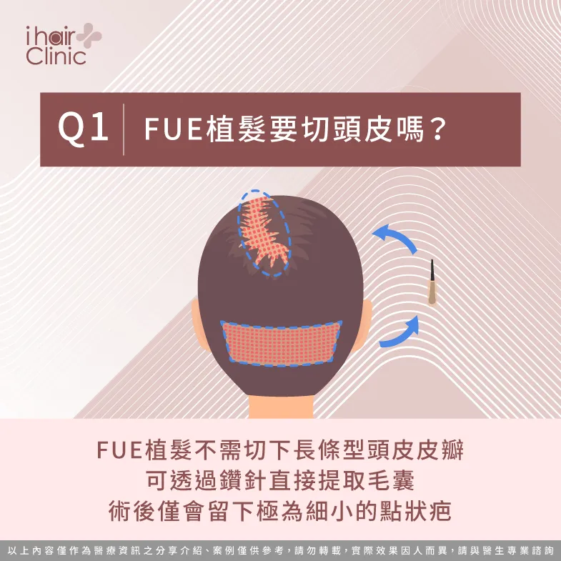 fue微創植髮不需切頭皮-fue微創植髮