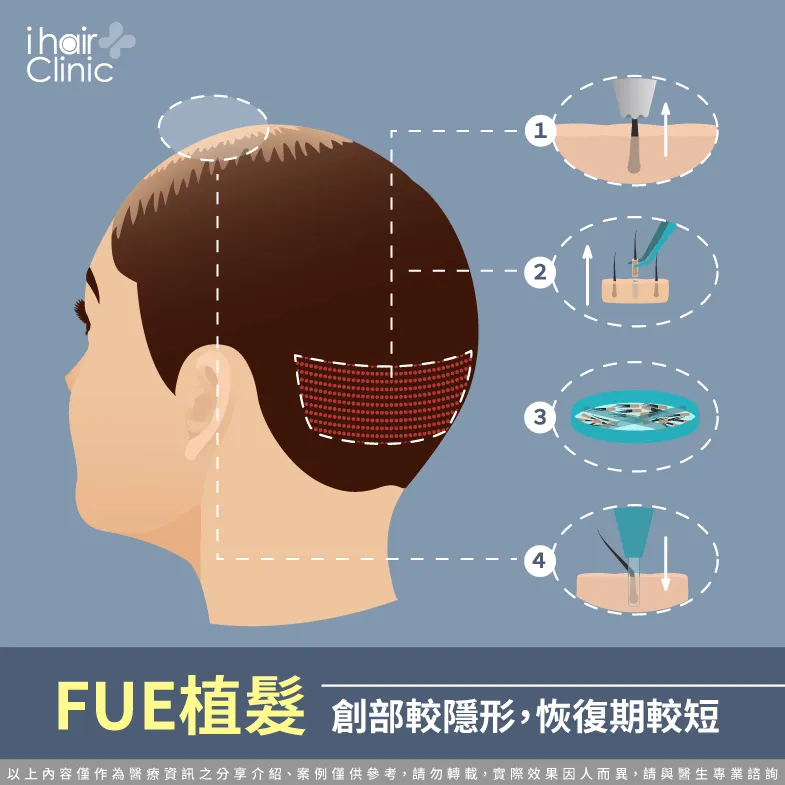 FUE植髮創口小恢復快-植髮fue和fut的差異