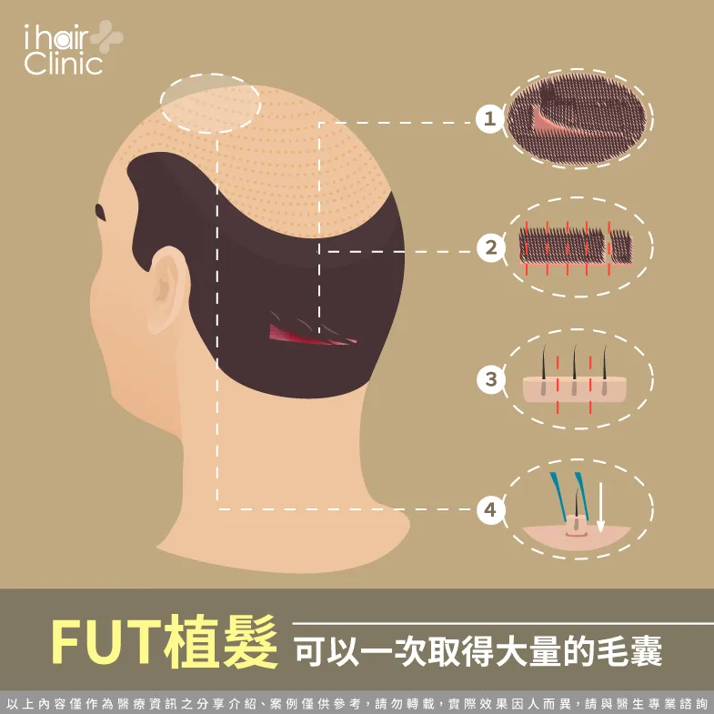 fut植髮可以一次獲得大量毛囊-植髮fue和fut的差異