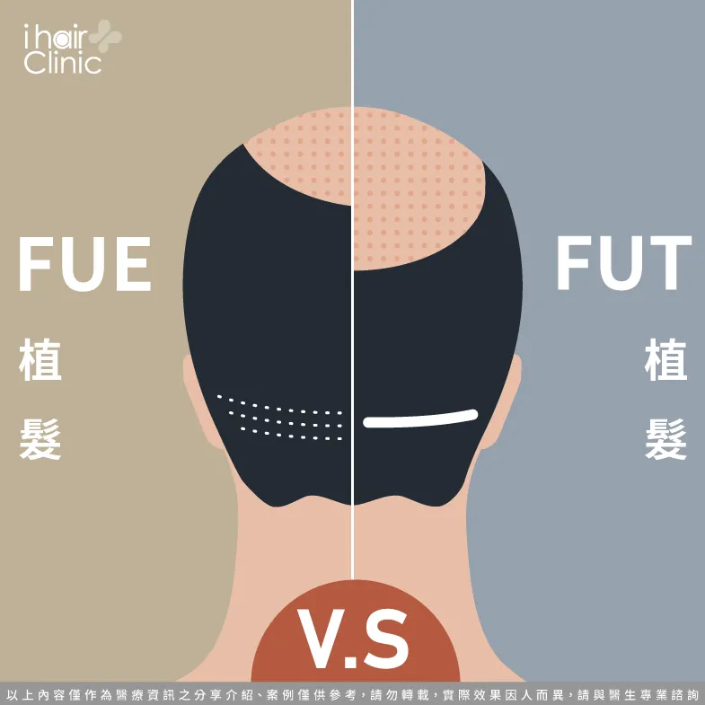 植髮fue和fut的差異-植髮fue和fut