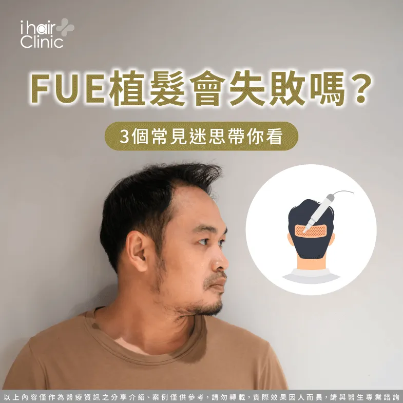 從3個觀點解析FUE植髮失敗機率-fue 植髮 失敗