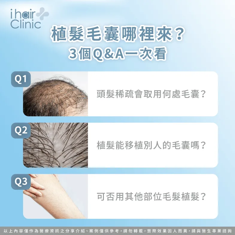 3個QA分析植髮會從哪裡取用毛囊-植髮 毛囊移植